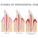 stages of gum disease