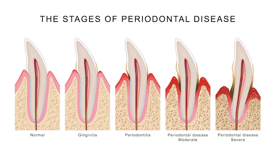 stages of gum disease