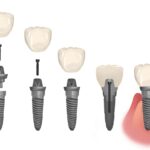 dental implants parts, dental implants faq