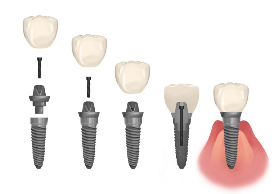 dental implants parts, dental implants faq